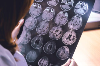 Exciting-Boost-in-Dementia-Research-as-Expanded-Grants-and-New-Initiatives-Launched